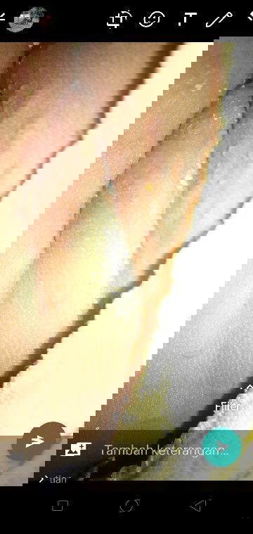 Ruam di leher Dan punggung