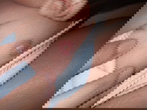 ปลูกฝีจากโรงบาล