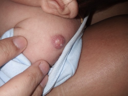 ปลูกฝีจากโรงบาล