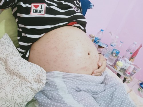 แม่คนไหนเป็นผื่นหนักขนาดนี้บ้าง