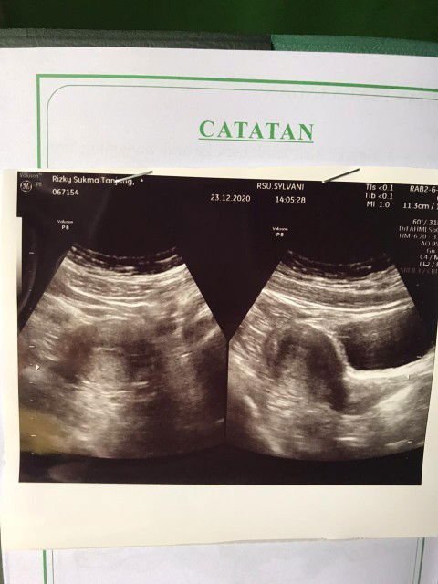 Bun Apakah ada yang ngalamin kayak aku?