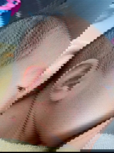 ตุ่มที่หน้าที่หัว