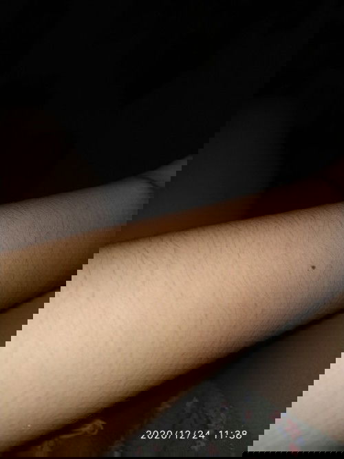 Bulu halus,di tangan, paha,kaki, perut