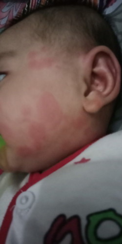 Merah merah di kulit bayi