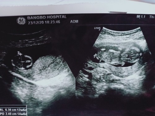 มีแม่คนไหนบ้างคะ 14 สัปดาห์เห็นลูกชัดขนาดนี้