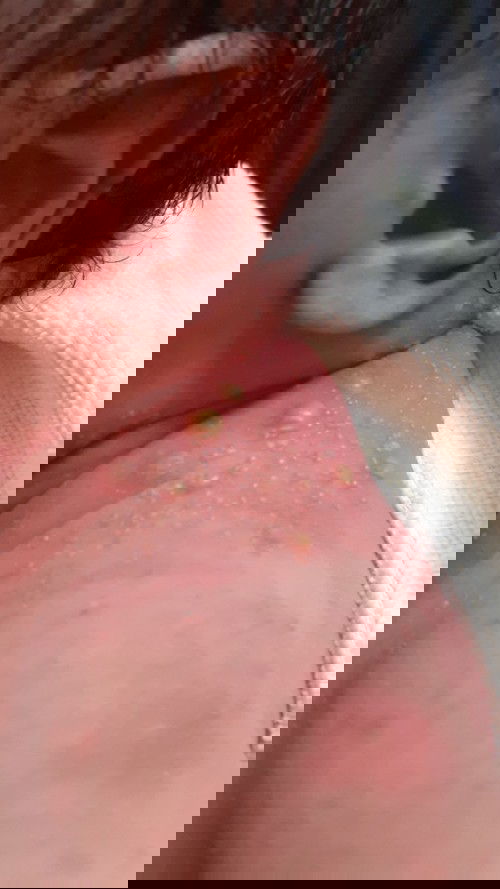 Bun ada yg kulit babynya gini knpa ya ini apa biang keringat??