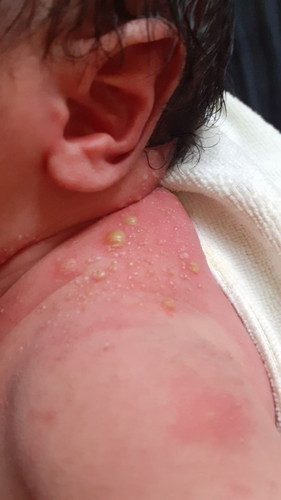 Bun ada yg kulit babynya gini knpa ya ini apa biang keringat??