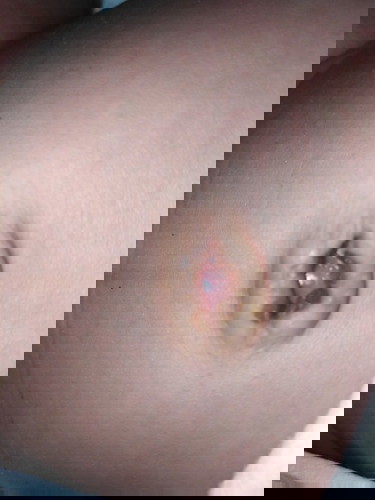 Pusod ng 1 month baby