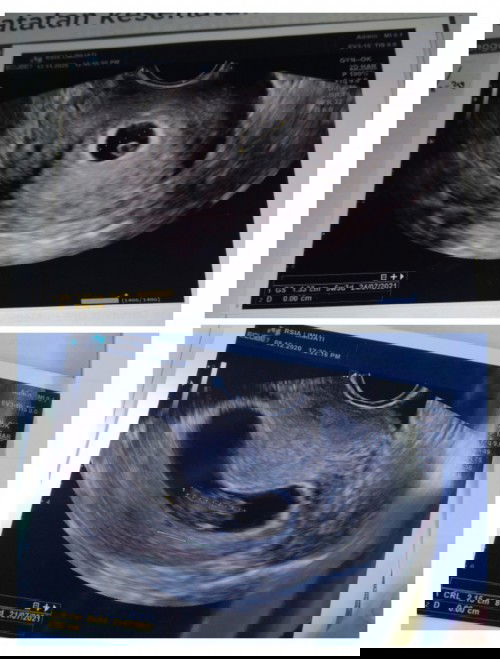 Mu tanya seputar usg setiap bulan nya berbahaya apa engga