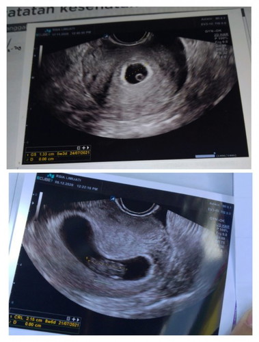 Mu tanya seputar usg setiap bulan nya berbahaya apa engga