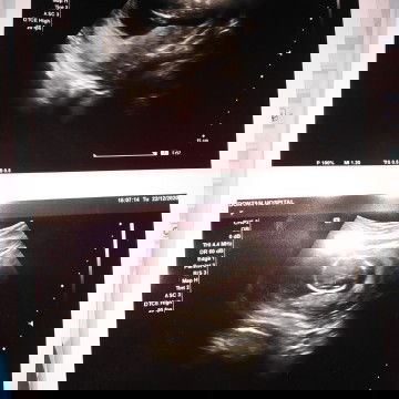 ท้อง2ค่ะท้องแรกแท้งตอนอายุ​ครรภ์​3เดือน