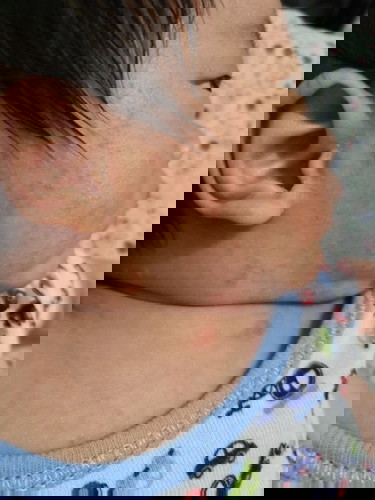 Baby's Rashes