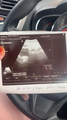 Peningla... Logik ke dah 5weeks 2 days kantung x kelihatan bila scan? Period delay 10 days. Ada sesape yg kes mcmni x?