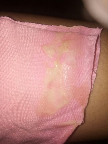 Mucus plug