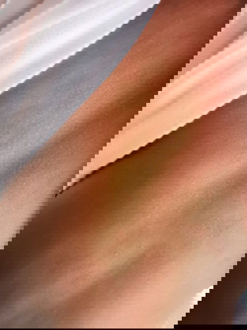 ผื่นขึ้นที่หลัง