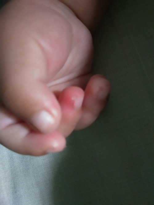 Jari tangan bengkak memerah