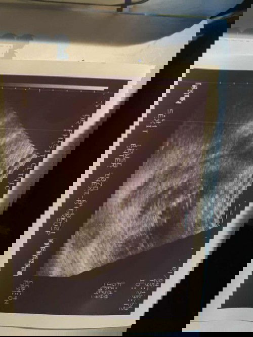 อาการดาวน์ซินโดม