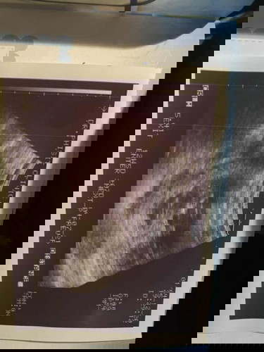 อาการดาวน์ซินโดม