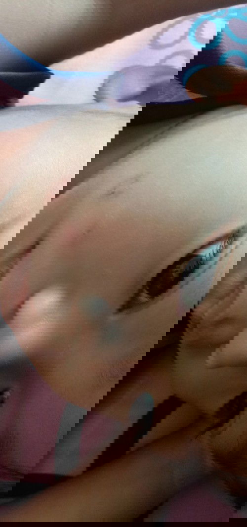 น้องเป็นอะไรไม่รู้ค่ะใครรู้ช่วยบอกทีนะค่ะตอนแรกน้องแค่เกาเฉยๆแล้วก้เป็นแบบนี้เลยค่ะกลัวมากเลยค่ะ