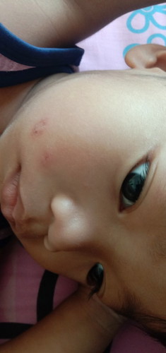 น้องเป็นอะไรไม่รู้ค่ะใครรู้ช่วยบอกทีนะค่ะตอนแรกน้องแค่เกาเฉยๆแล้วก้เป็นแบบนี้เลยค่ะกลัวมากเลยค่ะ