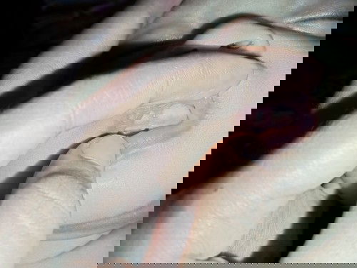 Gusi bengkak apakah ciri tumbuh gigi ?