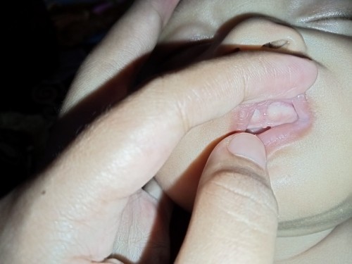 Gusi bengkak apakah ciri tumbuh gigi ?