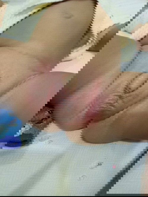 Ruam pada selangkangan.