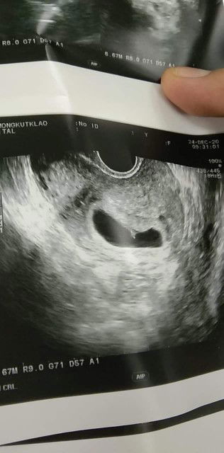 หมอบอกถุงตั้งครรภ์ไม่สวยอาจเป็นท้องลมซาวช่องคลอดก็ยังไม่เจอตัวเด็ก