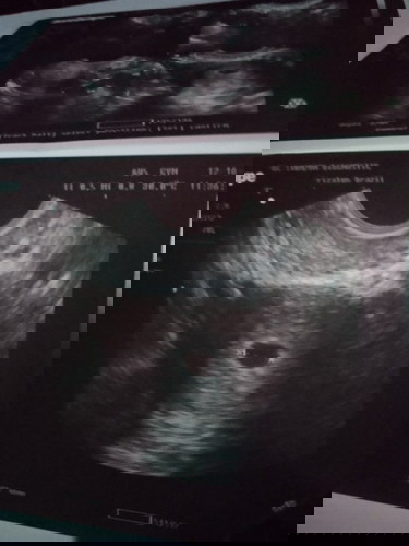 Gestitional Sac Seen