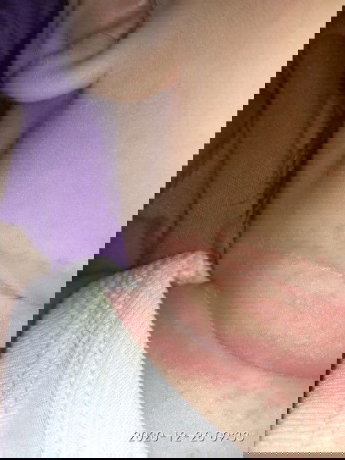 Ruam pada bayi 2 bulan