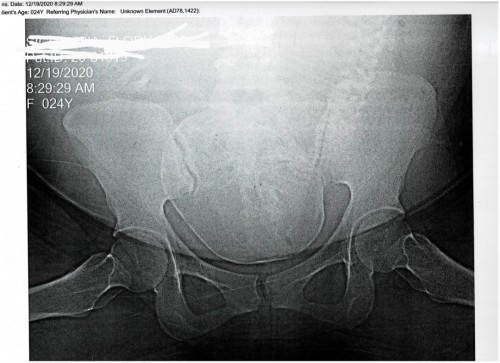 XRAY PELVIMETRY