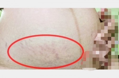 ท้องเริ่มลายทำไงดีคะ😑😑???เข้า 9 เดือนแล้วค่าา