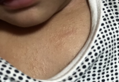 Spotting and redness