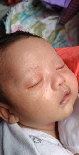 Rashes sa mukha at ulo ni Baby...