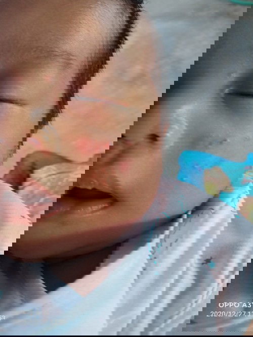 ลูก28วันแล้วมีผื่นขึ้นตรงแก้ม