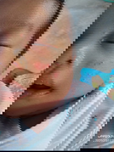 ลูก28วันแล้วมีผื่นขึ้นตรงแก้ม