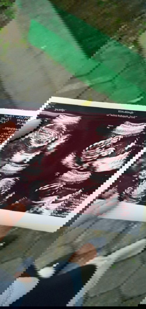 SAAT USG 24 WEEKS, JANIN MENUTUPI WAJAHNYA