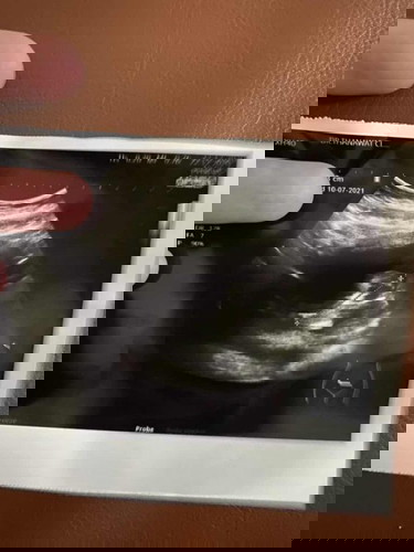 ฝากครรภ์ช้า