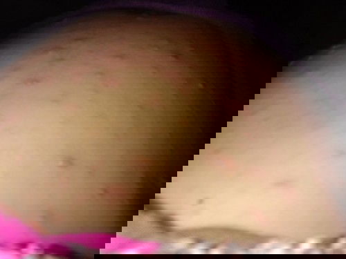 Hamil usia 30 minggu tertular cacar dari anak pertama