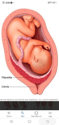 Placenta previa