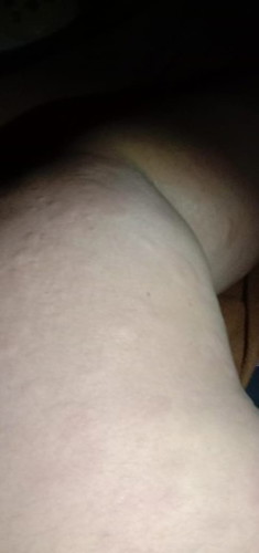 Gatal yang tak tertahankan aku sudah coba pakai bedak salisil