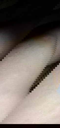 Gatal yang tak tertahankan