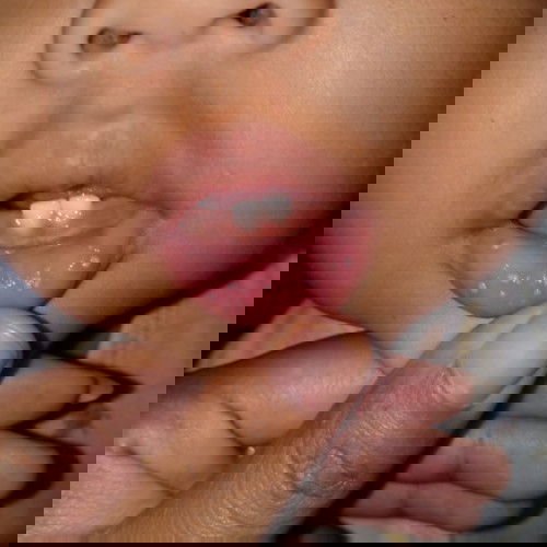 Sariawan nggk sembuh2