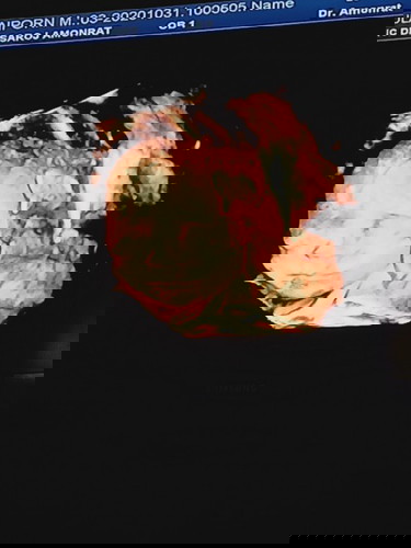 สอบถามหน่อยครับ  น้อง 33สัปดาห์    คุณหมอบอก น้ำหนักน้องต่ำกว่าเกณฑ์  ต้องทานไรคับ