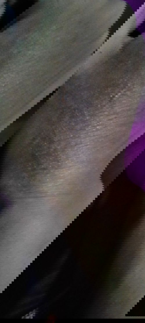 Gatal setelah melahirkan