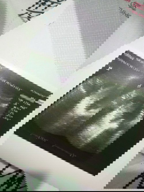 USG belum kelihatan janin dan usia kehamilan