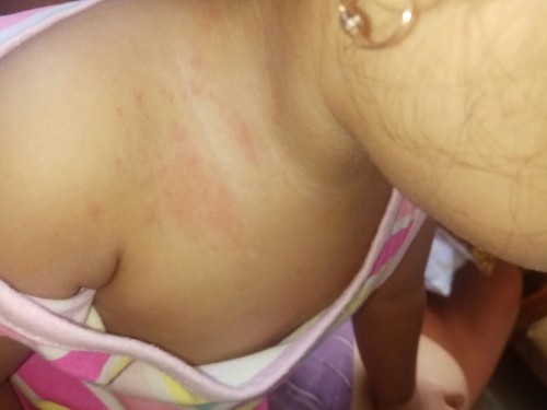 Bintik2 Pada Badan Anak