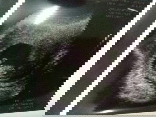 Hasil Scan baby di KKIA