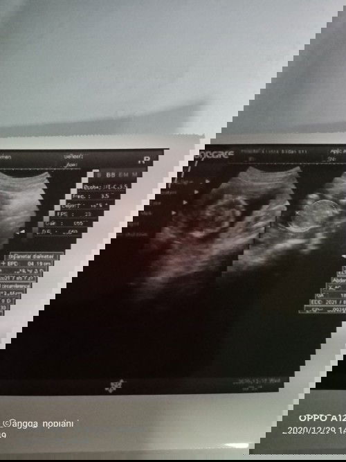 Ko usia janin di USG beda-beda ya....