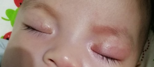 Mata anak merah